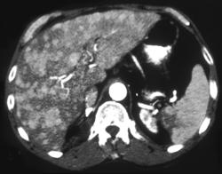 Multifocal Hepatoma - CTisus CT Scan