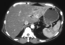 Cholangiocarcinoma - CTisus CT Scan