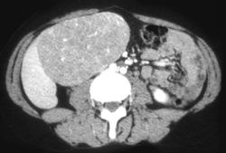 Hepatic Adenoma - Liver Case Studies - CTisus CT Scanning