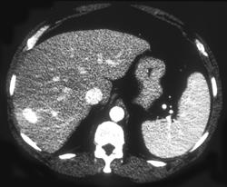 Hepatoma - CTisus CT Scan