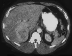 Cholangiocarcinoma - CTisus CT Scan