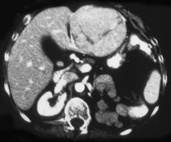 Hepatic Adenoma With Bleed - CTisus CT Scan