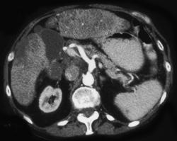 Fatty Liver - CTisus CT Scan