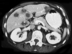 Metastatic Carcinoid to Liver - CTisus CT Scan