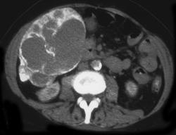 Hepatoma- Post Chemoembolism - CTisus CT Scan