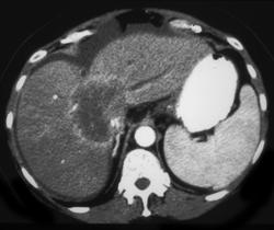 Cholangiocarcinoma - CTisus CT Scan