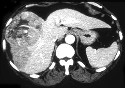 Hepatoma - CTisus CT Scan