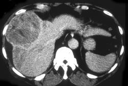 Hepatoma - CTisus CT Scan