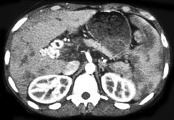 Portal Vein Thrombosis - CTisus CT Scan