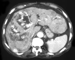 Hepatoma - CTisus CT Scan