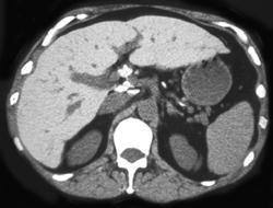 Hemochromatosis - CTisus CT Scan