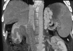 Gastric Varices - CTisus CT Scan