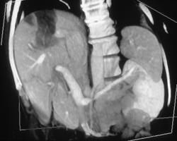 Radiofrequency Ablation (RFA) of the Liver - CTisus CT Scan