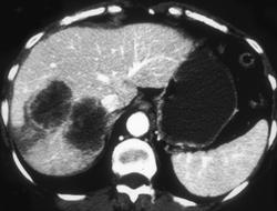 Cystic Hepatoma - CTisus CT Scan