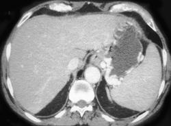 Gastric Varices - CTisus CT Scan