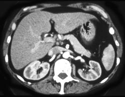 Liver Metastases - CTisus CT Scan