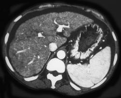 Cirrhosis - CTisus CT Scan