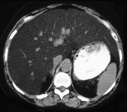 Fatty Liver - CTisus CT Scan