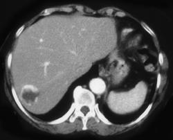 Hemangioma - CTisus CT Scan