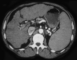 Cirrhosis - CTisus CT Scan