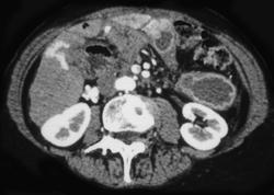 Cirrhosis With Venous Shunting - CTisus CT Scan