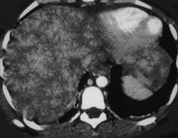 Cirrhosis - CTisus CT Scan