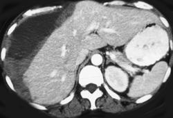 Subcapsular Hematoma - CTisus CT Scan