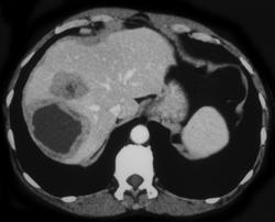 Amebic Abscess - CTisus CT Scan