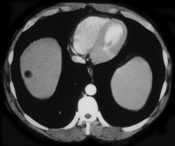 Liver Lipoma - CTisus CT Scan