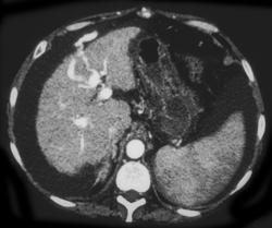 Cirrhosis - CTisus CT Scan