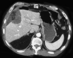 Spontaneous Rupture of A Hepatoma - CTisus CT Scan