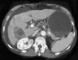 Hepatoma With Spontaneous Blood Flow - CTisus CT Scan