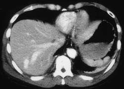 Av Shunting of the Liver - CTisus CT Scan