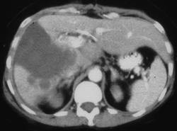 Hepatic Infarct - CTisus CT Scan