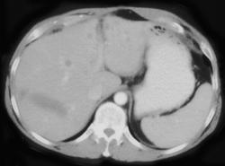 Liver Laceration - CTisus CT Scan