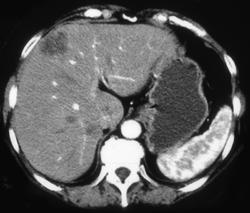 Liver Metastases (dual Phase) - CTisus CT Scan