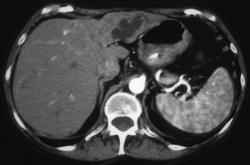 Cholangiocarcinoma - CTisus CT Scan