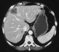 Metastatic Liver Diseasenot Seen on Portal Phase But Seen on Arterial Phase Images - CTisus CT Scan