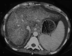 Fatty Liver - CTisus CT Scan