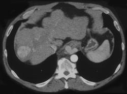 Hepatoma in A Cirrhotic Liver - CTisus CT Scan