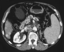 Multifocal Hepatoma - CTisus CT Scan