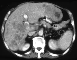 Hepatoma Invades the Portal Vein - CTisus CT Scan