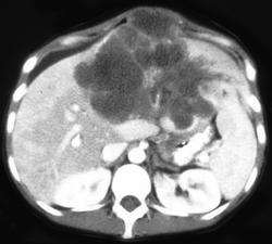 Hepatoma - CTisus CT Scan