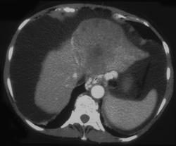 Hepatoma - CTisus CT Scan