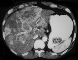 Hepatoma - CTisus CT Scan