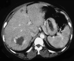 Hemangioma - CTisus CT Scan