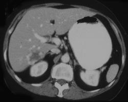 Hemangioma - CTisus CT Scan