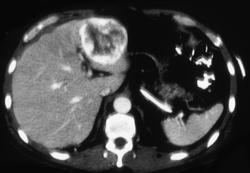 Hemangioma - CTisus CT Scan