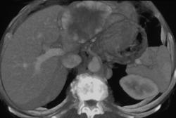 Hemangioma - CTisus CT Scan