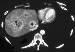 Metastatic Islet Cell Tumor - CTisus CT Scan